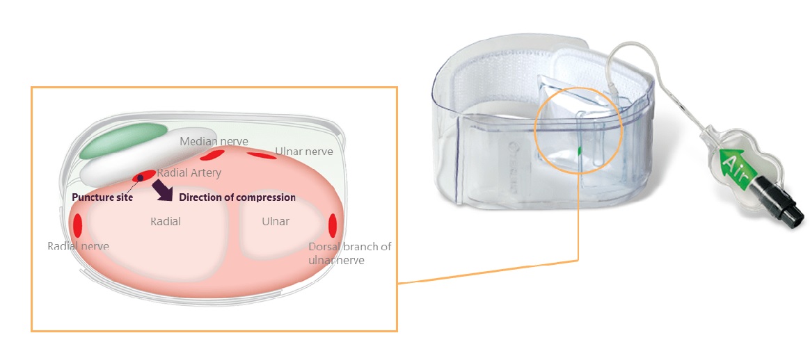 Introducer Radial Sheath